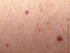 Moles can appear anywhere on the skin, alone or in groups. Red Moles On Skin Skinsight