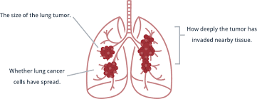 Many consider asbestos lung cancer and mesothelioma to be synonymous. Mesothelioma Lung Cancer Signs Symptoms