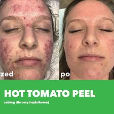 Hot Tomato Peel