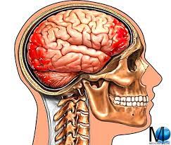 Cause, sintomi premonitori, diagnosi e cura. Emorragia Cerebrale Da Caduta E Trauma Cranico Sintomi Diagnosi E Cure Medicina Online