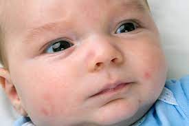Babyakne Was Tun Gegen Ausschlag Bei Babys Babymarkt De