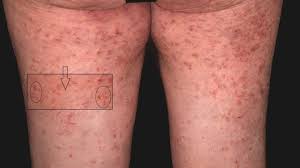 Image result for scabies norvegica