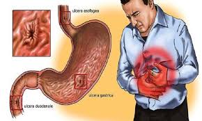 Resultado de imagen para mujer con gastritis