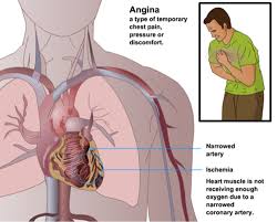 Image result for Angina Pectoris