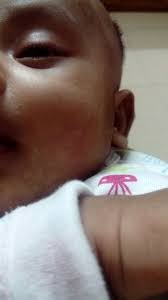 Check spelling or type a new query. My Daughter 3 Months Old In Her Face Has Some White Spots Around Mouth What