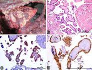 This type of mesothelioma develops in the lining of the lung cavity, known as the pleura, and is often revealed by a ct or mri of the chest. Scielo Brasil Fatal Hemothorax Caused By Pleural Mesothelioma In A Lion Fatal Hemothorax Caused By Pleural Mesothelioma In A Lion