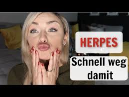 Ein bis zwei tabletten mit je 500 milligramm ass. Endlich Das Hilft Herpes Schnell Weg Bekommen By Gozde Youtube