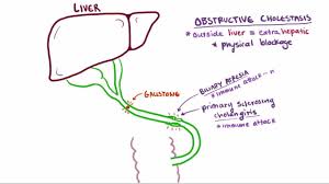 Image result for acholic stools human