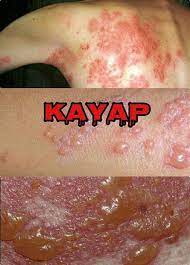 Ini adalah kerana kayak creek ini memberikan kestabilan yang tinggi dan mudah untuk dikendalikan. Kayap Jenis2 Kurus Sihat Dengan Scrub Moden Facebook