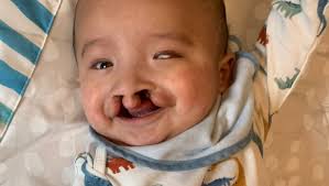 Fundraiser by Monica Avalos : Mateo's Forever Smile and Eartubes