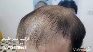 تركيب شعر طبيعي 100 مركز ايفل شبكي فرنسي الاصلي مختوم صنع في فرنسا التفاصيل في الوصف youtube