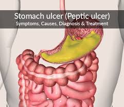 Stomach Ulcer Peptic Ulcer Symptoms Causes Diagnosis Treatment