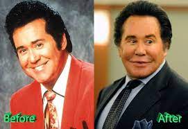 Then we let you decide if wayne newton plastic surgery before after facelift looks true or not. Wayne Newton Plastic Surgery Before And After Celebrity Plastic Surgery Wayne Newton Wayne Newton Plastic Surgery