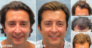 Propecia & rogaine hair loss medication. Bernstein Medical Hair Transplant Patient Norwood 3 Hairlosstalk Forums
