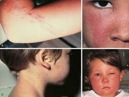 Image result for Rhus Dermatitis