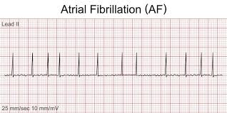 Image result for Atrial Fibrillation