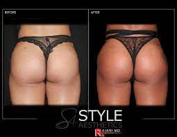 Topical and injected lidocaine is applied to the area to be injected. Non Surgical Brazilian Butt Lift Style Aesthetics By Rajanimd