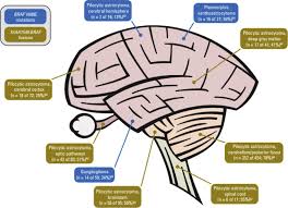 Read our overview of childhood brain tumors, or learn about specific types. Genetics Of Common Pediatric Brain Tumors Pediatric Neurology