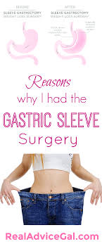 Why I Had The Gastric Sleeve Surgery Real Advice Gal Gastric Sleeve Diet Sleeve Surgery Gastric Sleeve