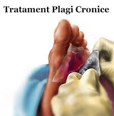 Sub forma de comprese pentru asemenea rani se foloseste sucul de aloe. Tratamente Rani Publicacoes Facebook