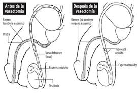 El tipo de cirugía que usted requiere para lograr revertir la vasectomía también marca una diferencia. Vasectomia En Malaga Tratamiento Urologico