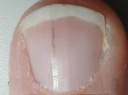 Splinter Fingernails Curious Symptom Caused By A Blow Or Possibly An Indication Of Heart Diseas Lines On Nails Nail Fungus Treatment Toenail Fungus Treatment