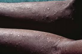 Image result for syphilis symptoms