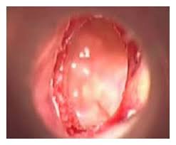Image result for Myringosclerosis