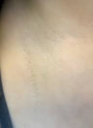 Seattle laser hair removal costs will vary from the national average due to geographical location and the individual physician. Laser Hair Removal Seattle Dr Javad Sajan
