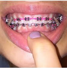 Follow Ya Average Girl For More Pins Cute Braces Colors Braces Colors Dental Braces Colors