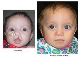 Check spelling or type a new query. Cleft Lip Before And After Photo Gallery Tufts Children S Hospital