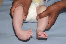 Club foot may result in developmental delays in walking, as the child may find it very difficult to walk in the beginning. Update On Club Foot Sciencedirect