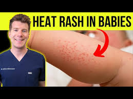 Image result for sweat rash on back baby