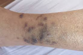 Lesions can occur singly, multiply in a limited area, or may be widespread. Cutaneous Kaposi S Sarcoma The Bmj