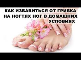 как избавиться от косточки на большом пальце в домашних условиях Kak Izbavitsya Ot Gribka Na Nogtyah Nog V Domashnih Usloviyah Bystro Youtube Nogti Nogi