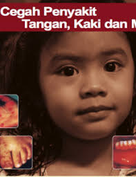 Penyakit ini terjadi disebabkan oleh virus enterovirus. Hfmd Penyakit Tangan Kaki Dan Mulut Bm Info Sihat Bahagian Pendidikan Kesihatan Kementerian Kesihatan Malaysia