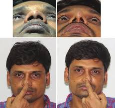 Three component cartilage framework reconstruction for correction of  post‑traumatic nasal septal collapse Original Article