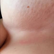 Image result for heat rash under breasts