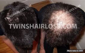 While the results of taking avodart will vary depending on the. Finasteride Or Dutasteride For Hair Loss Top Hair Loss Treatments