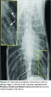 In lung cancer, cells grow uncontrollably beyond the normal life cycle of a cell. Bronchiectasis Vetfolio
