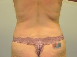 How much is a bbl in michigan. Liposuction Michigan Grand Rapids Mi Liposuction