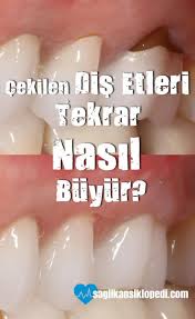Cekilen Dis Etlerini Dogal Tedavi Ile Eski Haline Cevirin Dogal Tedaviler Dis Dogal