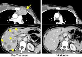 Learn about signs of liver cancer that has spread to the organ from another part of the body. Immunotherapy Targets Metastatic Breast Cancer Cell Mutations National Cancer Institute
