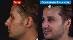 Doc Dr Seckin Ulusoy On Instagram Burun Estetiginde Gec Donem Sonuclar Onemlidir Burun Tikanikligi Ve Estetik Sikayetleriyle Basvuran Hastamiza 1 Yil Once