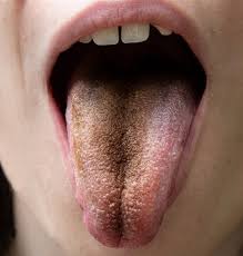 Image result for black tongue symptoms