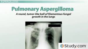 There are several different types of aspergillosis. What Is Aspergillosis Fungal Infections Symptoms Video Lesson Transcript Study Com