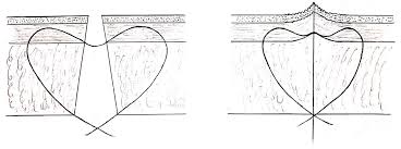 Its disadvantage is a relatively high pr. Different Suturing Techniques In Thoracic Incision Protocol For A Feasibility Randomised Controlled Trial Bmj Open