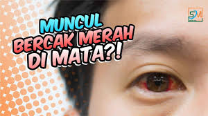 Maybe you would like to learn more about one of these? Mengapa Muncul Bercak Merah Pada Mata Youtube