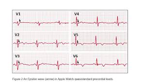 Image result for Epsilon Wave