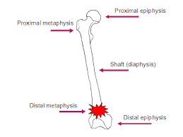 osteoporosis and spinal cord injury united spinal association